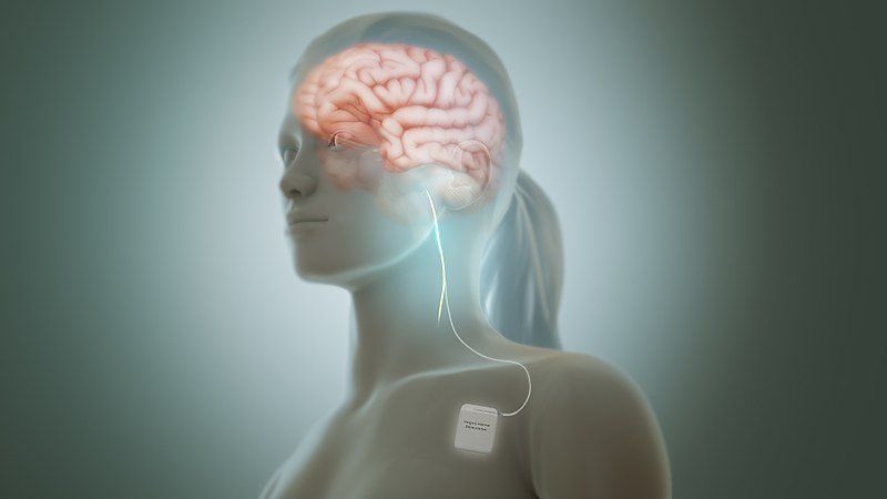 The Science Behind Vagus Nerve Stimulation: A Breakthrough in Neurological Care