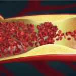 The Rise of Mechanical Thrombectomy Devices in Stroke Treatment