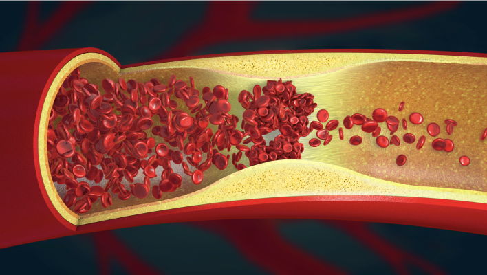 The Rise of Mechanical Thrombectomy Devices in Stroke Treatment